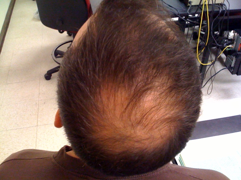 does hair regrow after hair loss